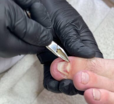 Terapia onycholizy